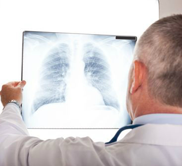 A tüdőrák tünetei - Milyen panaszokra figyeljünk?